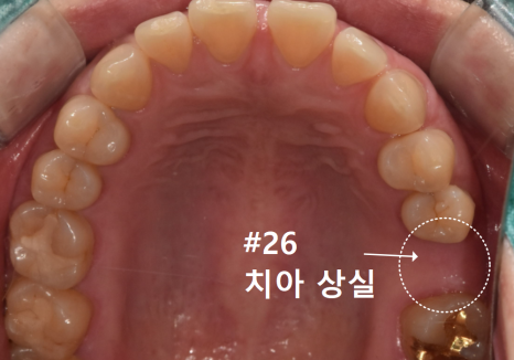 고덕동 치간 이개, 위 앞니 벌어짐, 교정? 라미네이트? 고민이시라면 필독 관련 이미지 4