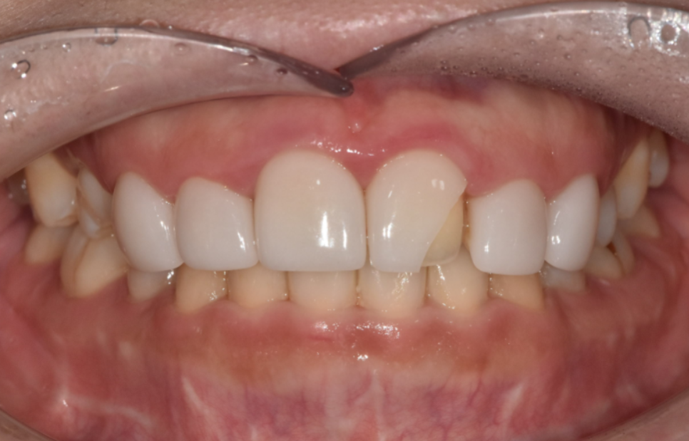 라미네이트 깨짐 원인 TOP 3, <대표원장>이 직접 알려드립니다 관련 이미지 1