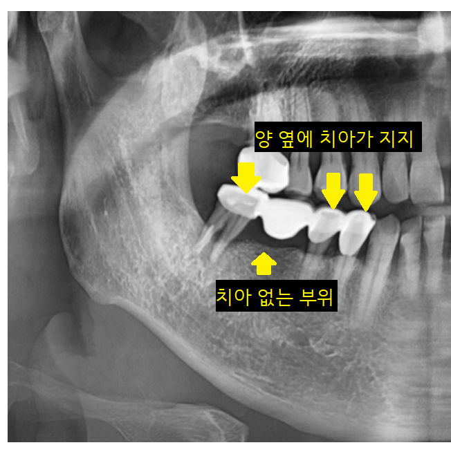 오래된 브릿지 보철 제거 후 고덕역 임플란트 교체 케이스 관련 이미지 3