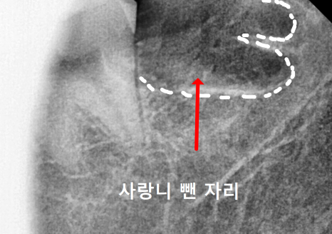 상일동 사랑니 매복 방치하다 옆 치아까지 망가진 실제 사례 관련 이미지 12