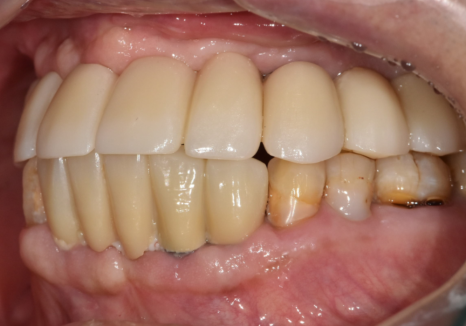 뼈가 없어서 안 된다구요? 70대 당뇨 무치악 환자분의 전체 임플란트 사례 관련 이미지 19