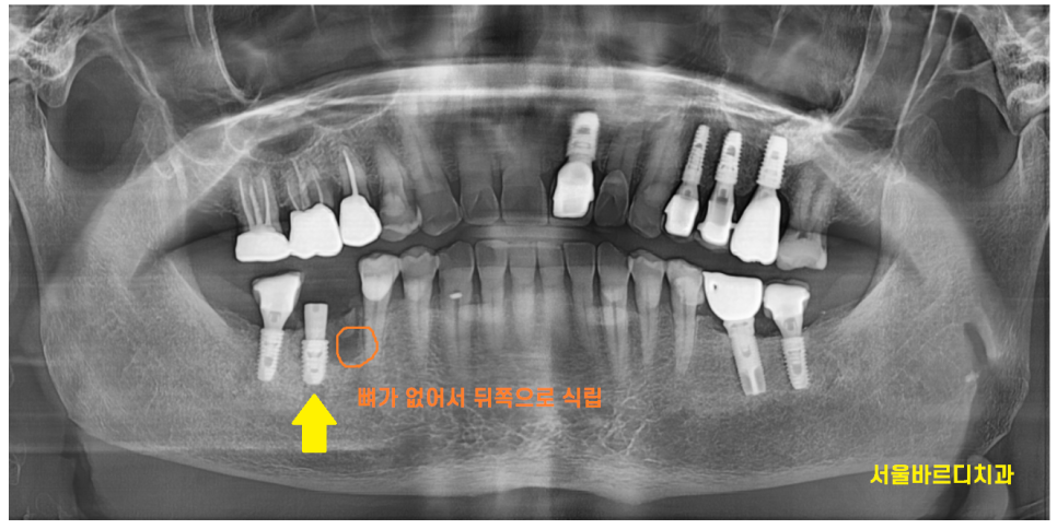 암사동 치과 치아 뿌리 균열 금 갔을 때 임플란트 치료로 행복해지세요. 관련 이미지 5