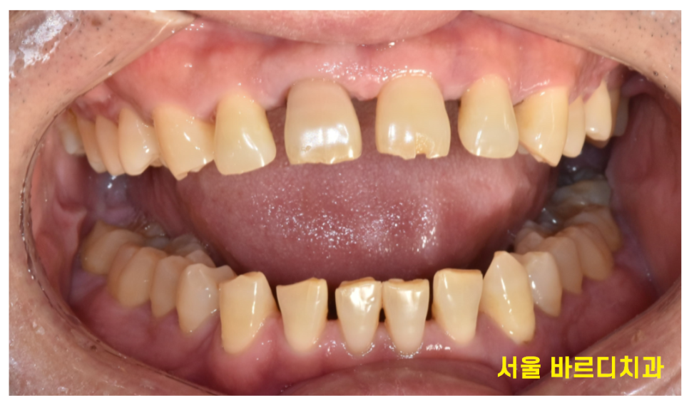 앞니 사이 간격 넓어짐 치아가 벌어져서 보기 싫을 때 크라운 치료 관련 이미지 2