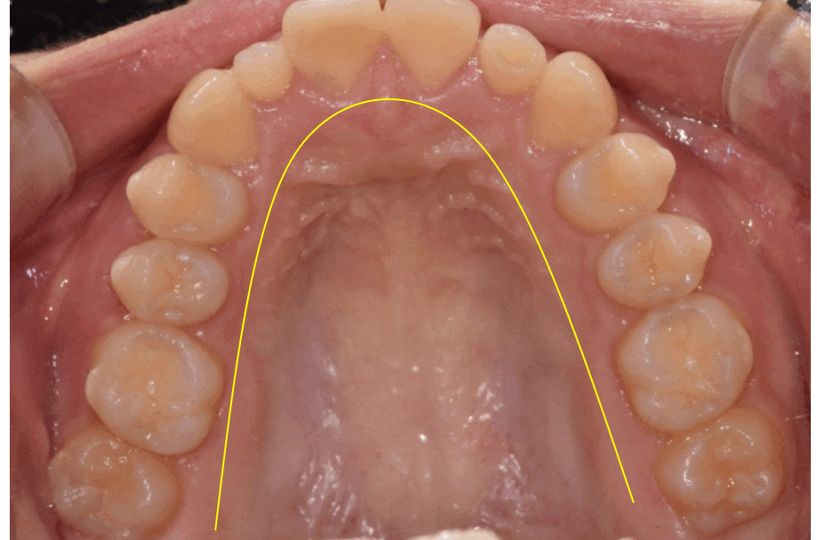 Microdontia Orthodontics Can Restore Balance and Alignment of the Teeth. image 1