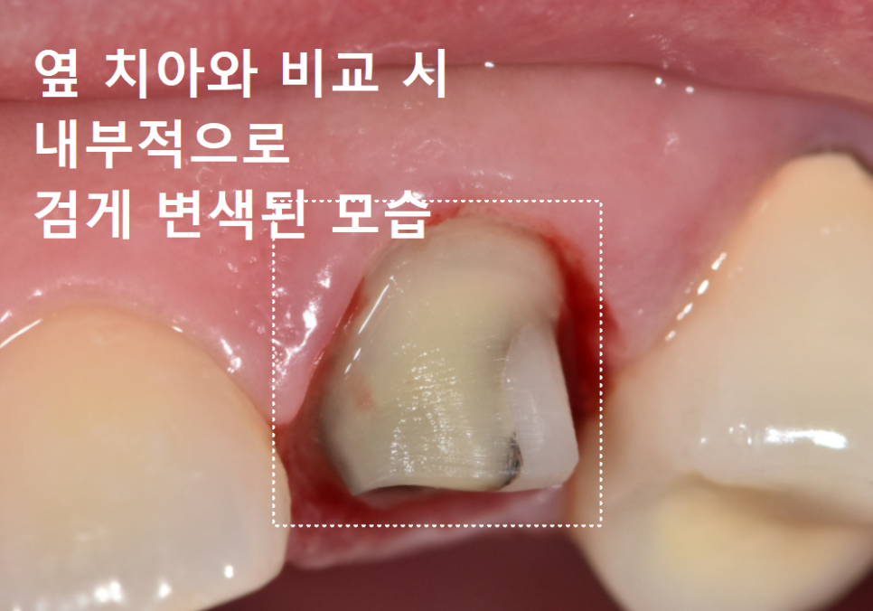 앞니가 검게 변색된 이유, 신경치료 후 꼭 크라운으로 씌워야 하는 걸까요? 관련 이미지 7