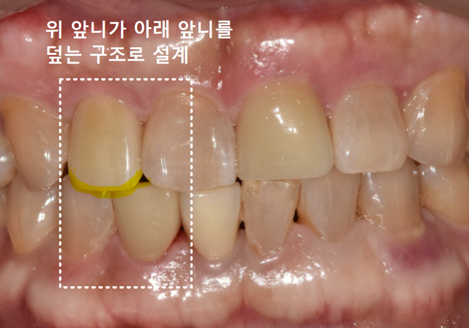 앞니 깨짐 치료 비용, 더이상 치과에 돈 낭비하기 싫다면? 깨지는 원인부터 알아야 합니다. 관련 이미지 13
