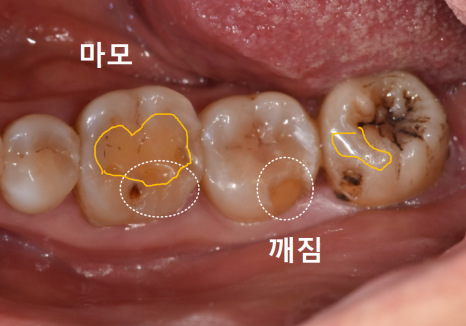 대문니 파절, 앞니에 금이 쩍 갈라졌다면? 딱딱한 음식을 조심해야 하는 이유 관련 이미지 6