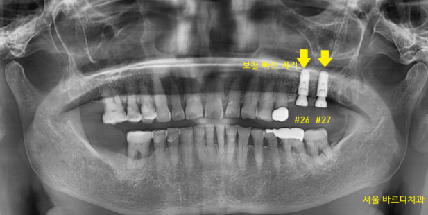 치아 크라운 빠짐 살릴 수 없을 때 강일역 임플란트 관련 이미지 7