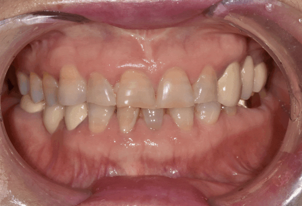 누런 치아 연예인치아 처럼 하얗게 만들 수 있나요? 관련 이미지 5