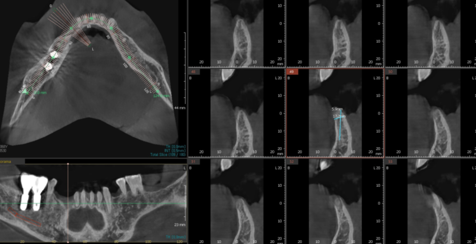 하남시청치과 디지털 임플란트를 고집하는 이유 관련 이미지 8