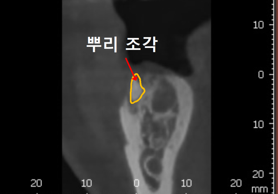 어금니 덧니 때문에 임플란트 해야 한다고요? 방치하면 안 되는 이유 관련 이미지 8