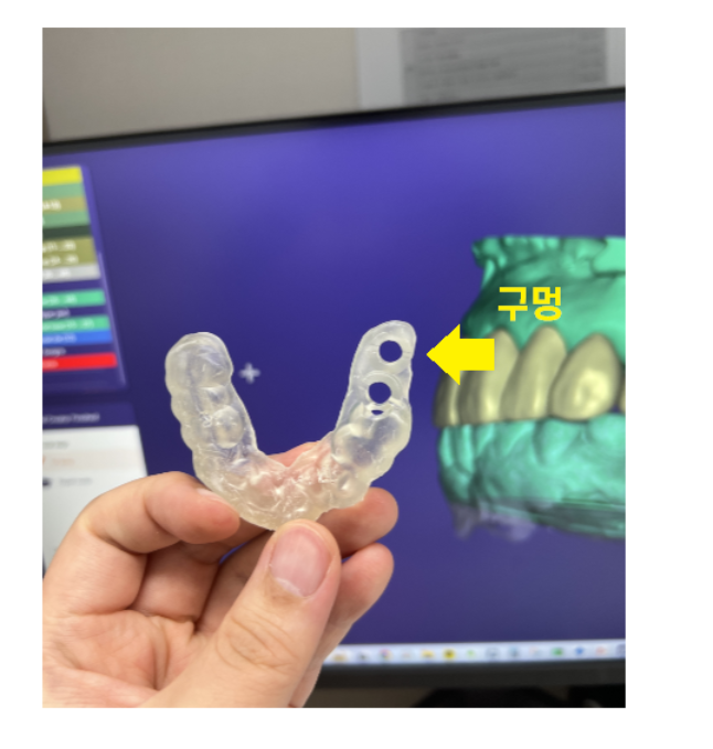 어금니 임플란트 1개 가격 왜이렇게 천차만별일까? 관련 이미지 5