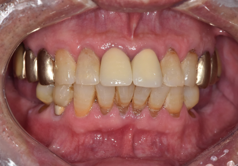 강동구 임플란트 가격 줄이는 방법 2개 발치했는데, 1개만 심어도 된다구요? 관련 이미지 5