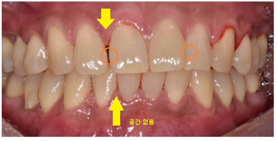 고덕 그라시움 치과 벌어진 앞니 메꾸기 당일 레진으로 치료했습니다. 관련 이미지 3