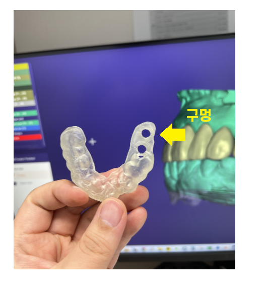 고덕동 치과 임플란트 거부감이 있었지만 네비게이션 수술법으로 해결했습니다. 관련 이미지 9