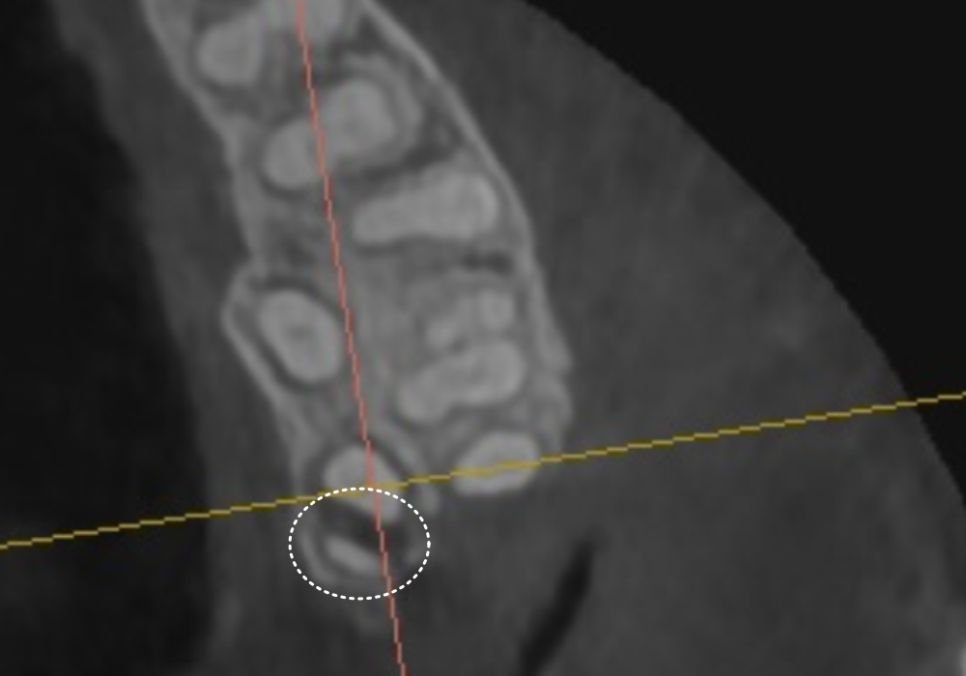 어금니 금 감, 치아 살릴 수 있는 기준은 바로 관련 이미지 8