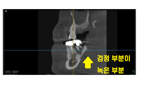 이 흔들림으로 발치 후 뼈이식 진행한 케이스 관련 이미지 1