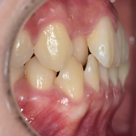 Sangil-dong Orthodontic Dentist: Do Protruding Front Teeth Really Need Orthodontic Treatment? image 9