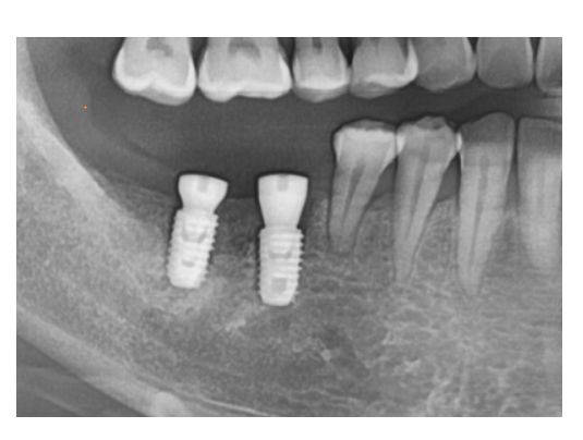 고덕동 임플란트 골이식 필수일까? 궁금증 여기 모두 있어요 관련 이미지 5