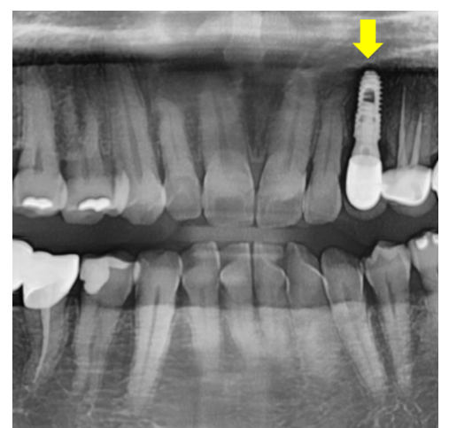 Orthodontic Bracket Debonding: Please Pay Attention If You Have Many Prosthetic Restorations image 5