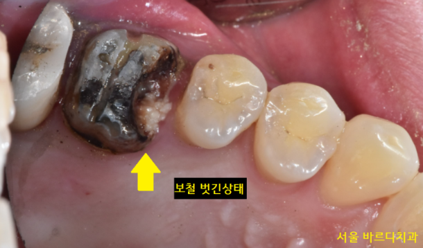 상일동치과 비가역적 치수염 치아 심폐소생했습니다. 관련 이미지 4