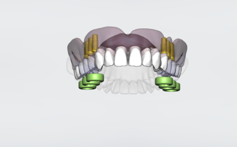 고덕동 치과 뼈이식 동반 양쪽 어금니 임플란트 동시 진행 관련 이미지 5
