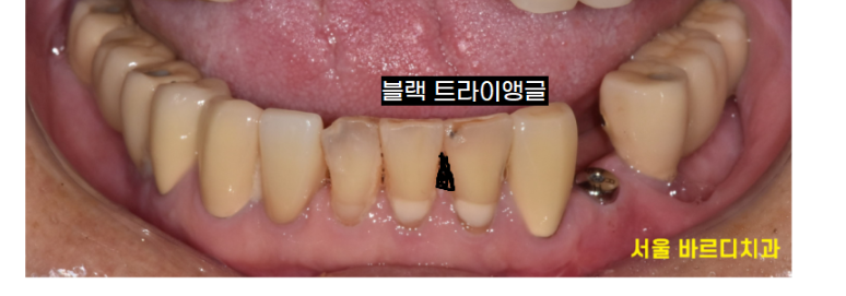 강동구 스케일링 치아 삭제 한다고 오해하지 마세요! 관련 이미지 2