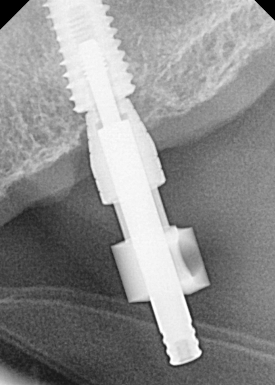 Is It Difficult to Shorten the Implant Procedure Period? Why It Differs from Person to Person image 2