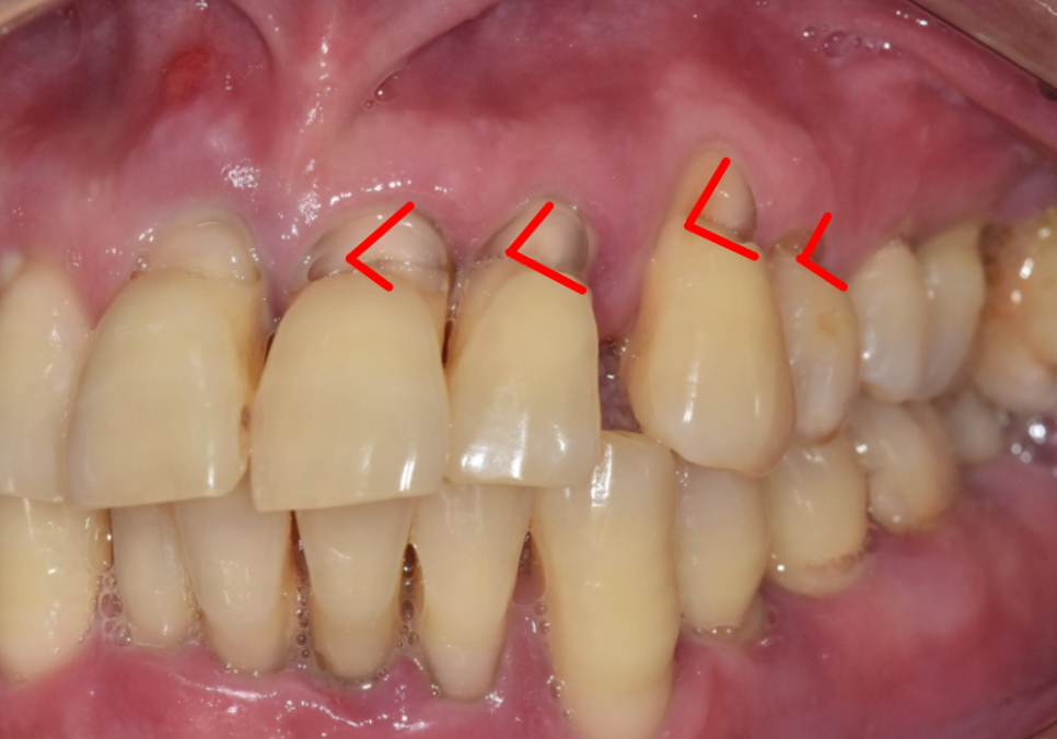 치아 시림 증상 때문에 고민이신가요? 그렇다면 양치질 너무 열심히 하지 마세요. 관련 이미지 3