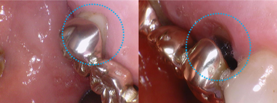 고덕동치과 서울바르디치과 전치부 및 구치부 임플란트 치료증례 #9 관련 이미지 15