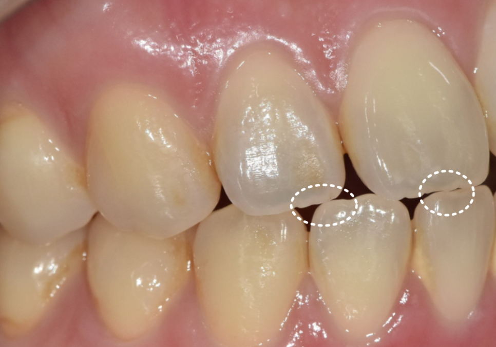 절단교합으로 인한 앞니 레진 깨짐, 교정 없이 해결한 사례 관련 이미지 3