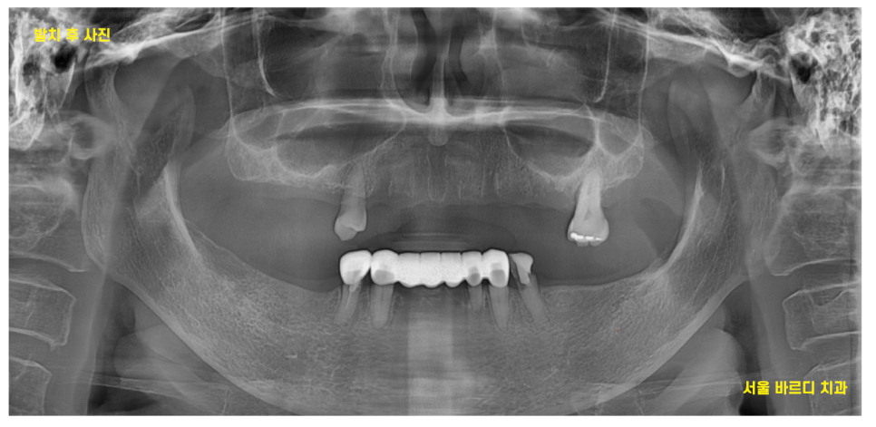 암사동 치과 전악 임플란트 하루만에 끝냈습니다. 관련 이미지 9