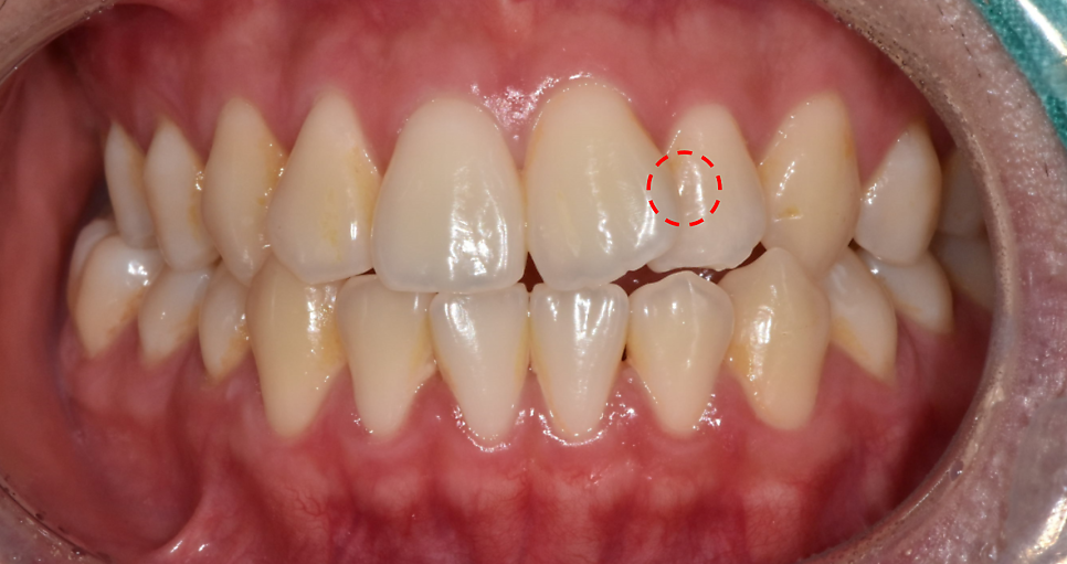 Godeok Station Dental Clinic: If You’re Considering Starting Adult Clear Aligners, Click image 5