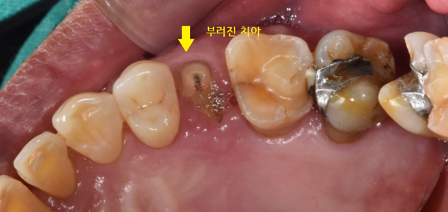 강일동 치과 치아 부러짐 붙일 수 있을까요?? 관련 이미지 3