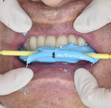 외국인 치과 진료 하악 전체 임플란트 7개 심어 12개 치아 만들기 관련 이미지 11