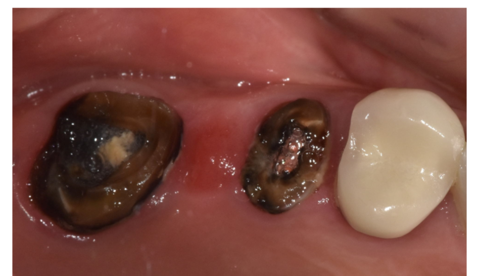 임플란트 대체 수술이 부담스러울 때는 브릿지 치료 관련 이미지 3