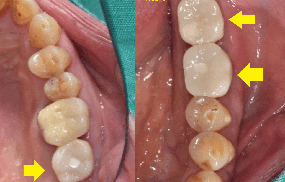 고덕동 치과 어금니 흔들림과 통증 임플란트가 답일 때! 관련 이미지 1