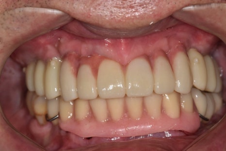 얇은 잇몸뼈, 임플란트 거부 당했다면? 상악동거상술로 해결할 수 있습니다. 관련 이미지 16