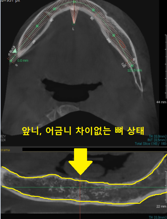 상일동 근처 치과 얇은뼈 틀니 안될 때 해결 방법은?? 관련 이미지 5