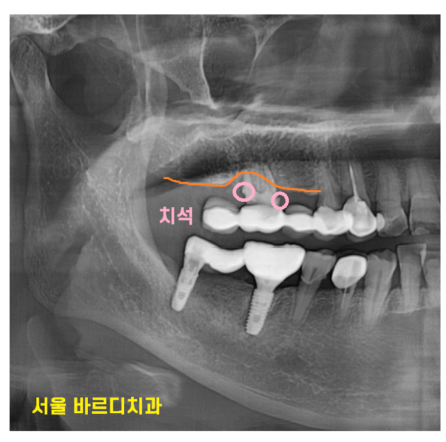 풍산동 치과 임플란트 시술후 통증 부작용은 아닐까? 관련 이미지 3