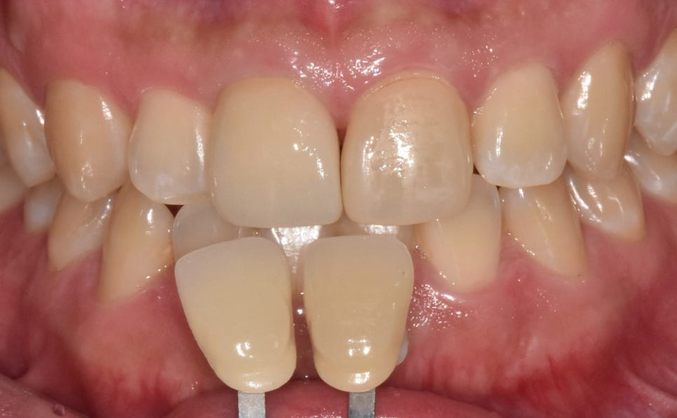 Gangdong-gu laminate failure and detachment: front teeth restored through retreatment image 6