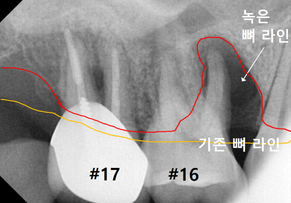 상악동 거상술 부작용 걱정되시나요? 재수술 없는 뼈이식의 정석 공개 관련 이미지 5
