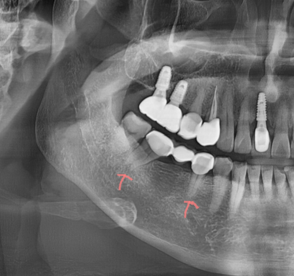 임플란트 대체 수술이 부담스러울 때는 브릿지 치료 관련 이미지 1