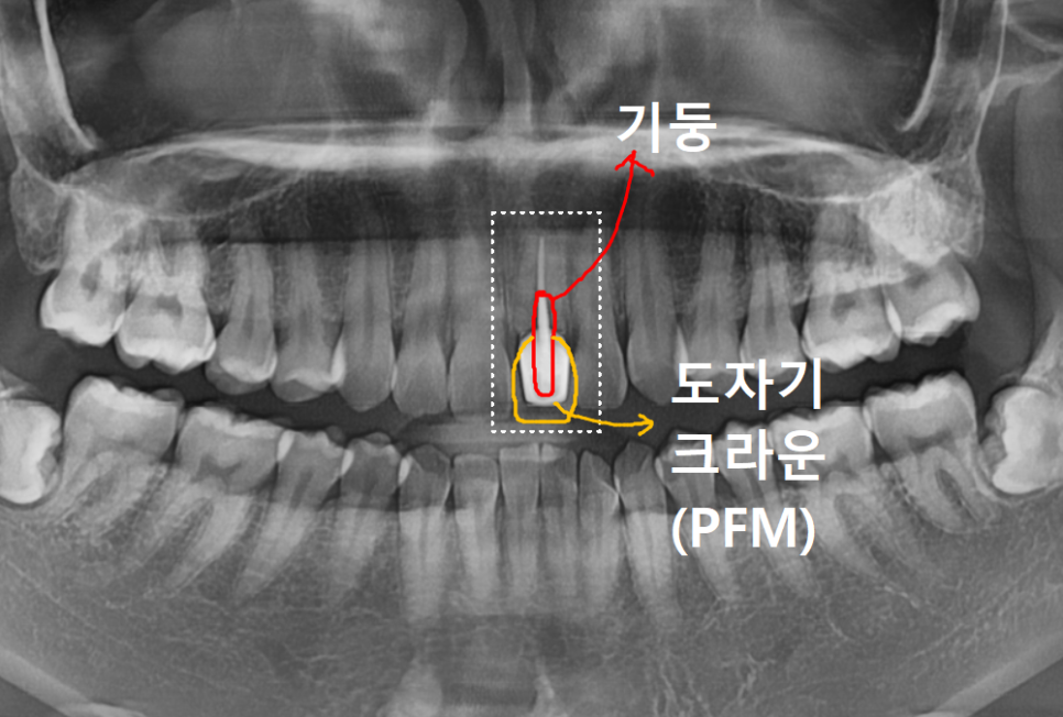 명일동 치과, 잇몸이 검게 변했다면? 앞니 변색 원인은 바로 관련 이미지 11