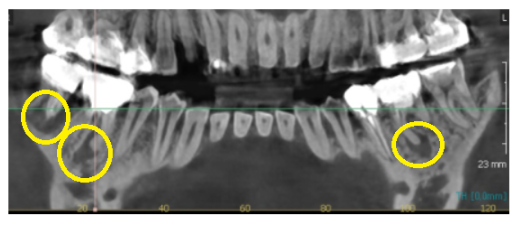 강일동 치과 잇몸뼈 녹음 발치 후 임플란트로 해결했습니다. 관련 이미지 4