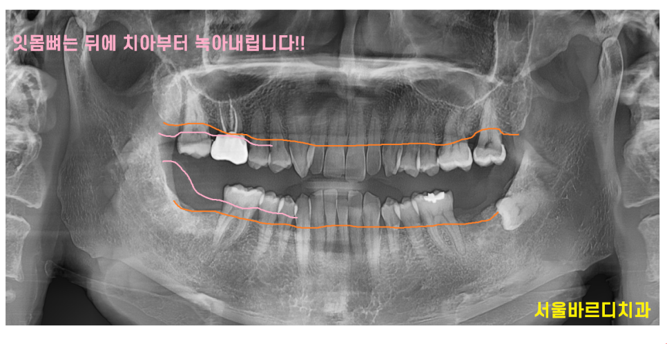 고덕동 치과 심한 치주염에는 oooo 치료가 제격입니다!! 관련 이미지 2
