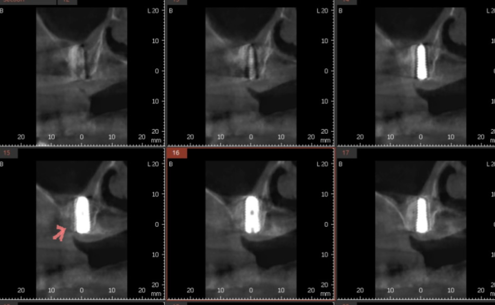 위아래 임플란트 동시에 하여 치료기간 단축하기 관련 이미지 5
