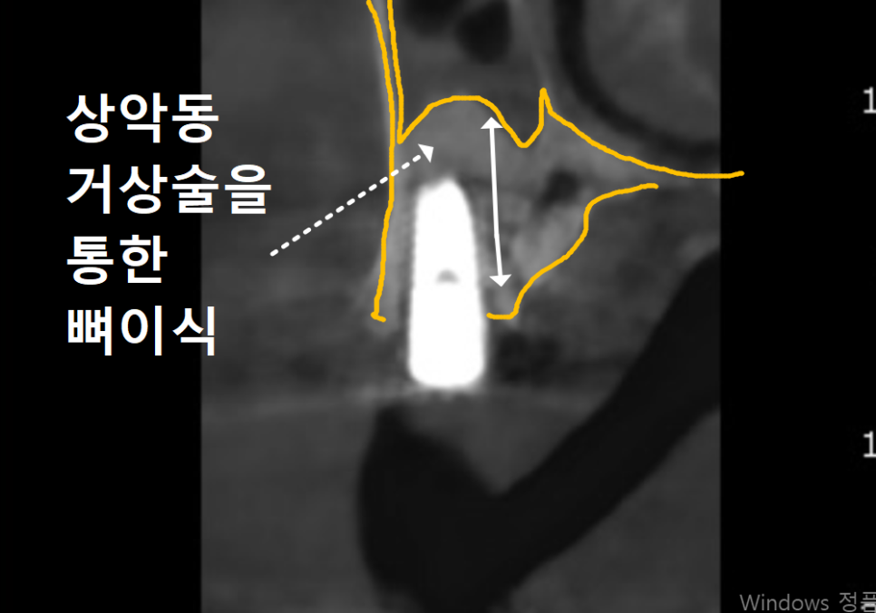 Gangil-dong Molar Implant, "It’s Loose—Can’t You Just Bond It with Resin?" image 11