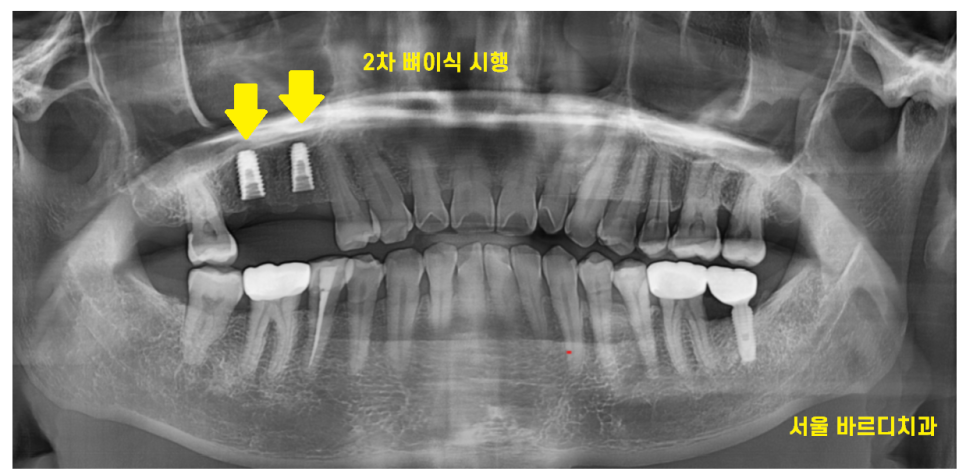 고덕역 임플란트 잇몸 뾰루지 뼈이식 두번 하여 해결했습니다. 관련 이미지 9