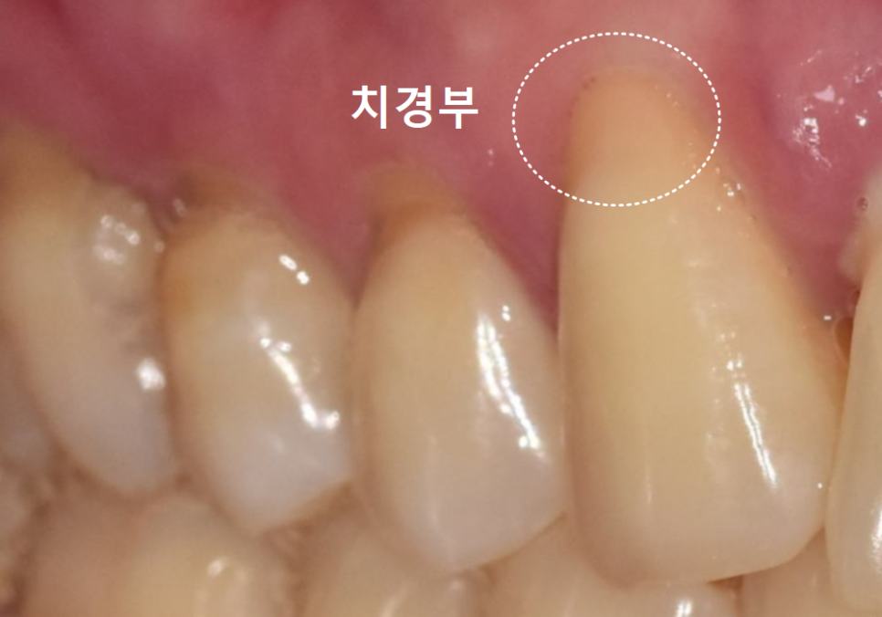 치아 시림 증상 때문에 고민이신가요? 그렇다면 양치질 너무 열심히 하지 마세요. 관련 이미지 2